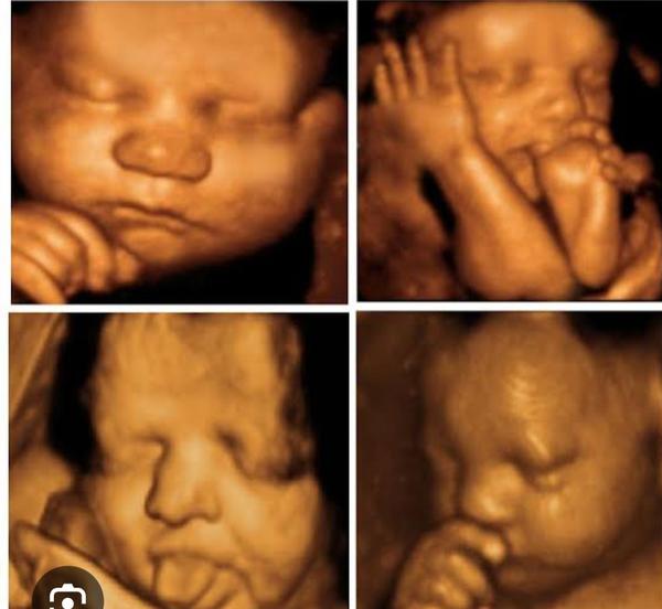 fetal growth assessment rohini