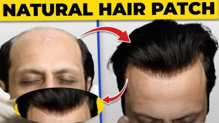 Australian hair patch in Rohin