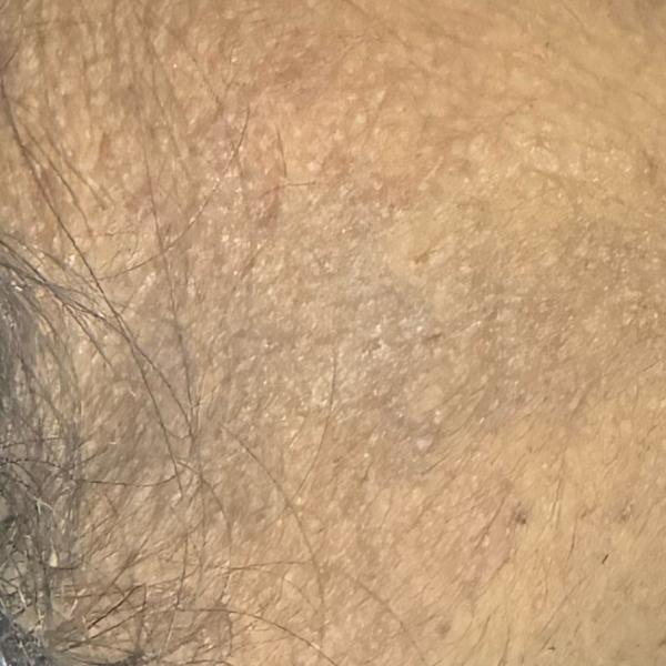 best psoriasis treatment in tr