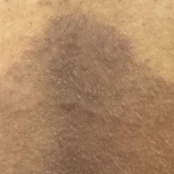 best dermatologist for dandruf