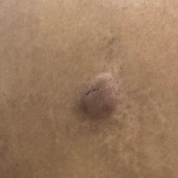 keloid treatment in trichy