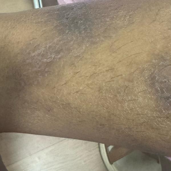 best psoriasis treatment in tr