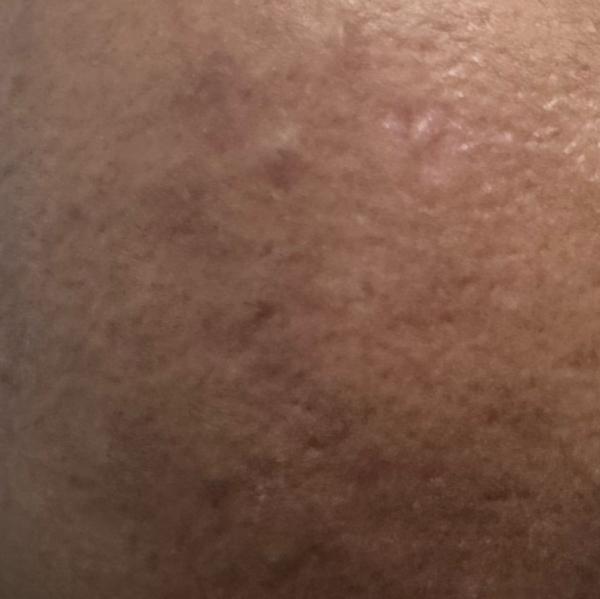 dermatologist for pigmentation