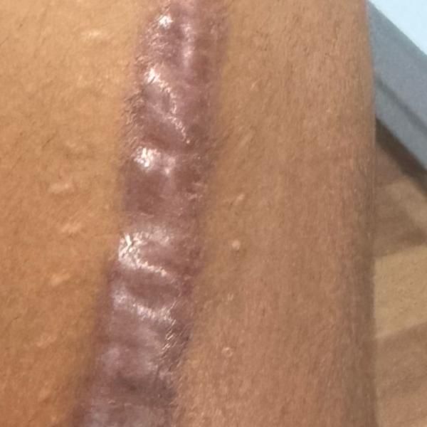 treatment for keloid and hyper