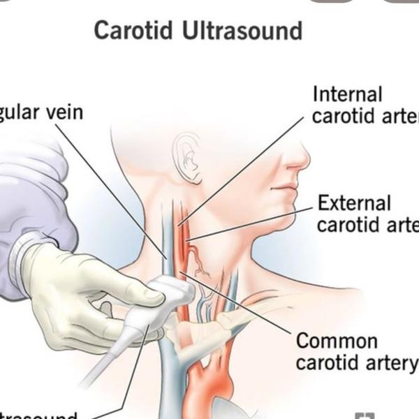 carotid doppler ultrasound in 