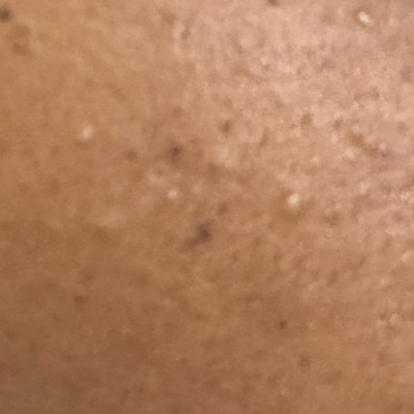 Dr. Valarmathi, a skin doctor