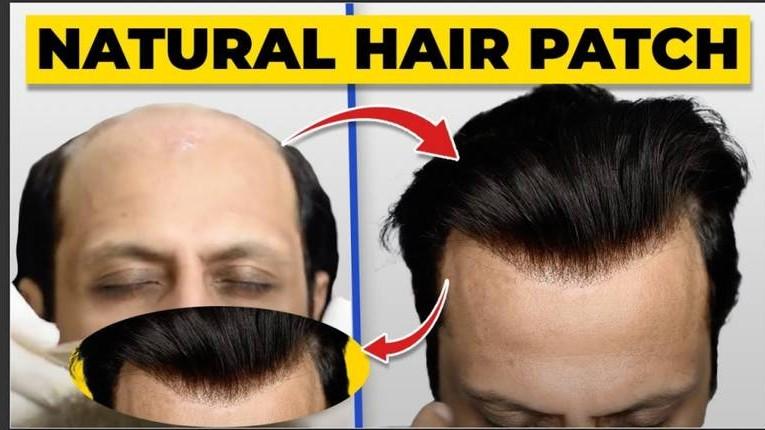 Best Australian Forntlace Patc