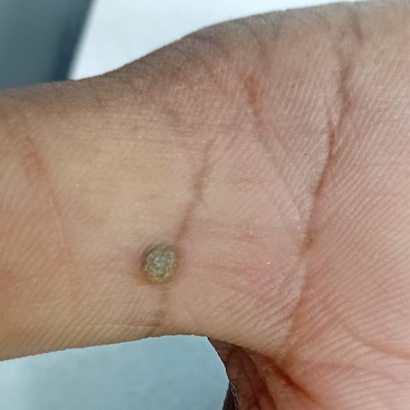 best wart removal treatment