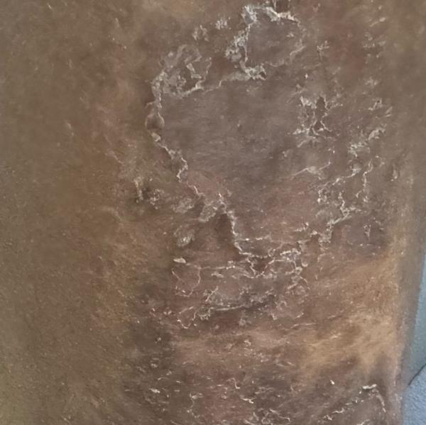 best psoriasis treatment in tr