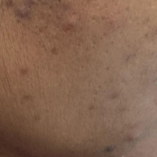 pimples treatment in trichy
