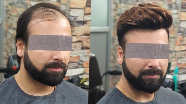 Australian hair patch in Rohin