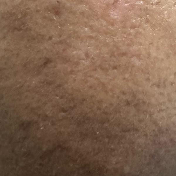 acne treatment specialist in t