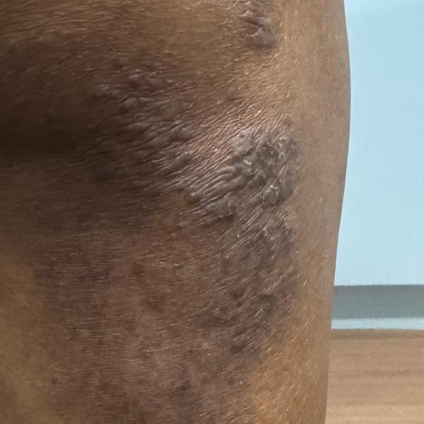 dermatologist expert in eczema