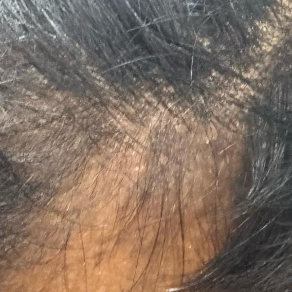 top rated hair fall treatment