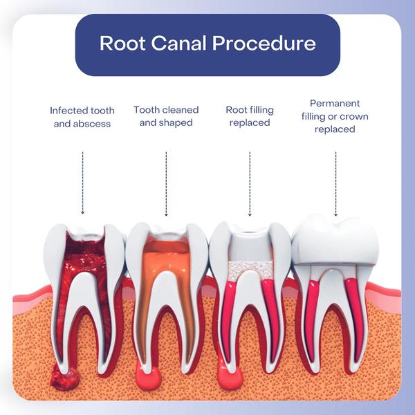 Pain-free Root Canal Treatment
