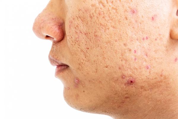 Acne scars can be frustrating 