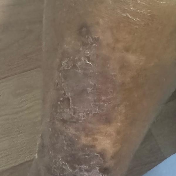 skin allergy and eczema treatm