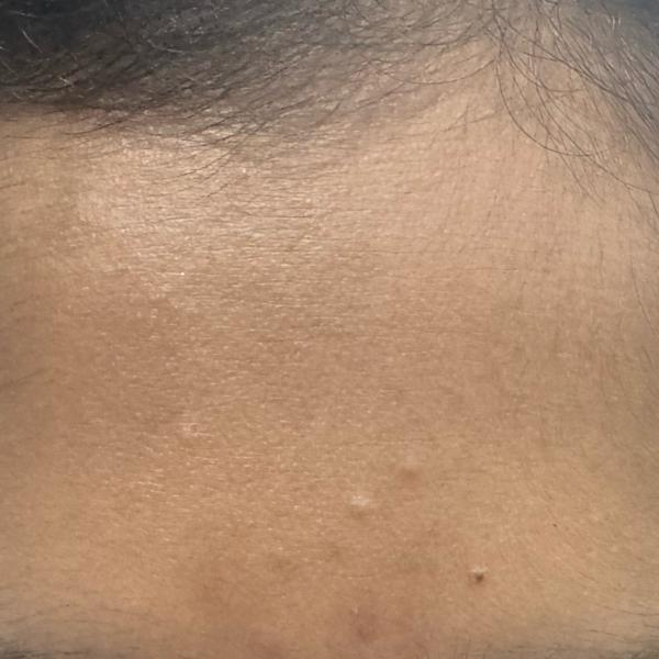 acne treatment in woraiyur
