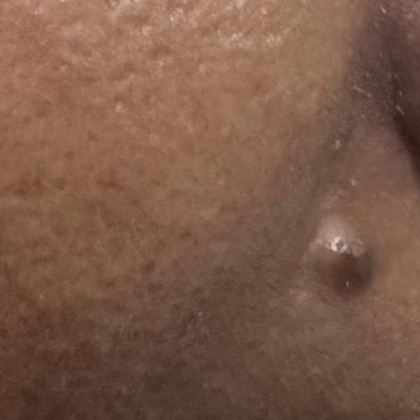 earlobe repair expert in trich