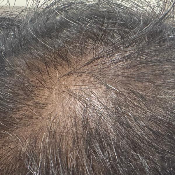 best hair loss treatment trich