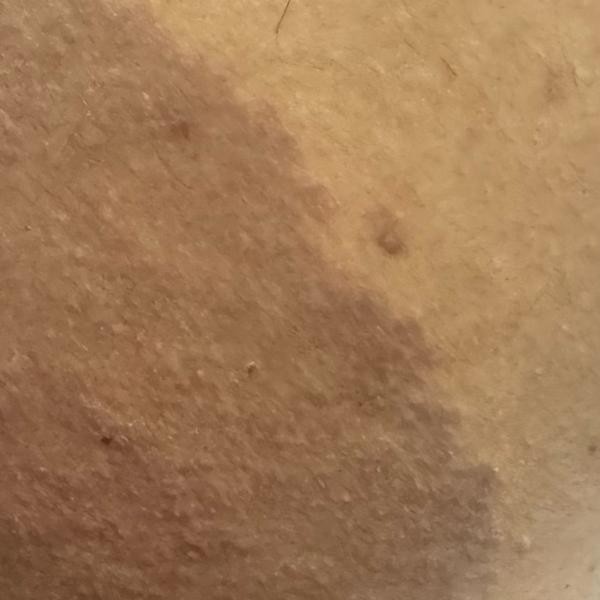 best treatment for fungal infe