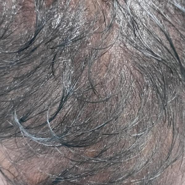 prf treatment in trichy