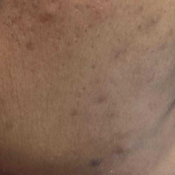 acne treatment in woraiyur