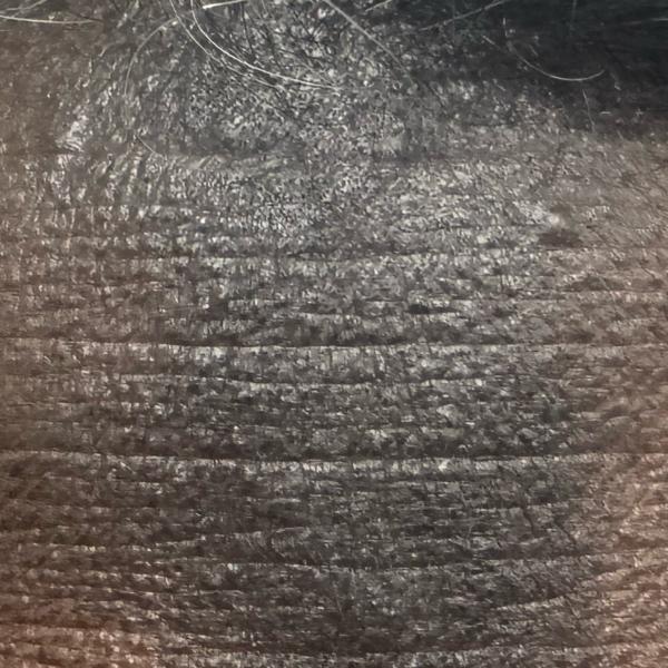 acne treatment in woraiyur