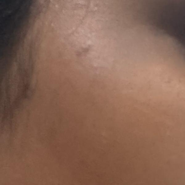 best dermatologist for acne wo
