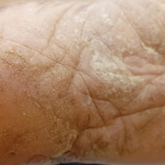 trichy skin allergy treatment 