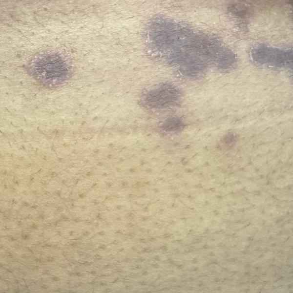 fungal infection doctor near m