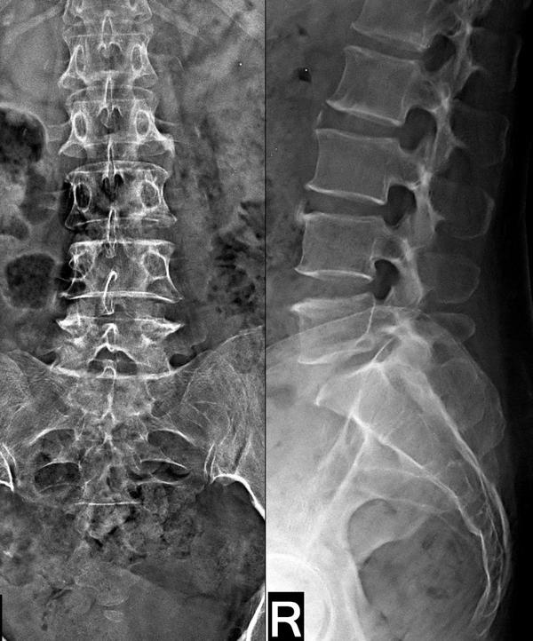 lumbosacral spine x ray rohini