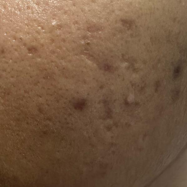 acne treatment in woraiyur