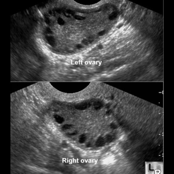 ultrasound for ovulation cycle