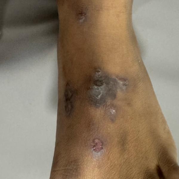 skin doctor in trichy 2 eczema