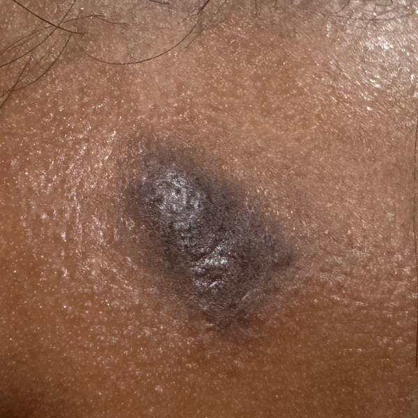 eczema treatment specialist tr