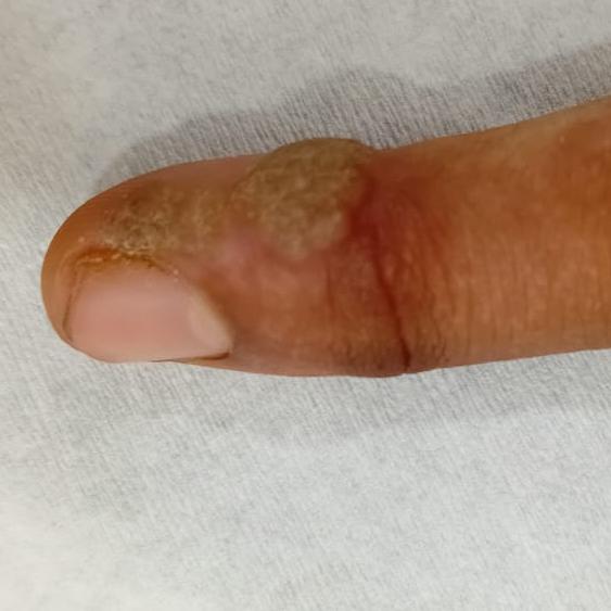 removal of skin tag in trichy