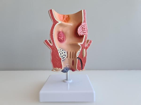 piles surgery consultation san