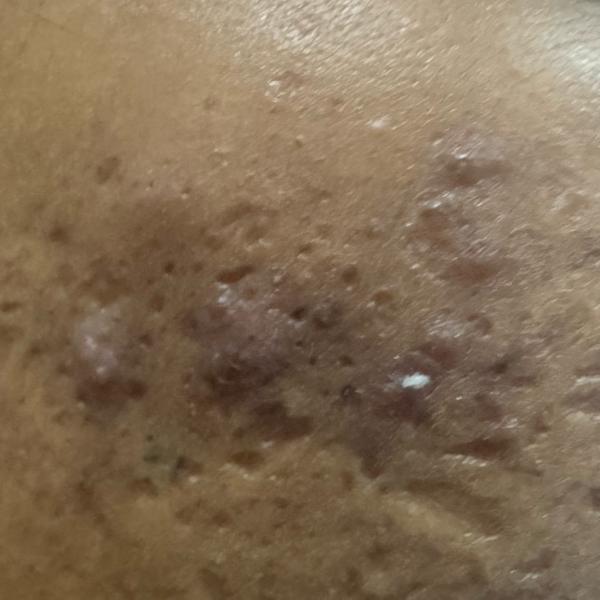 best acne doctor trichy