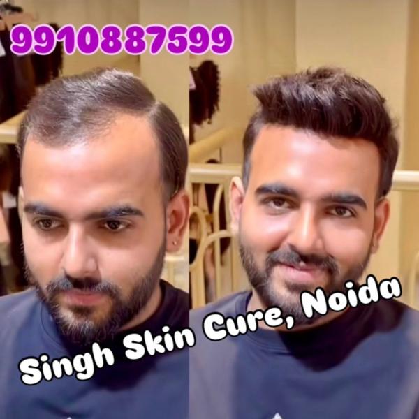Hair Replacement Sevice Available in Sec