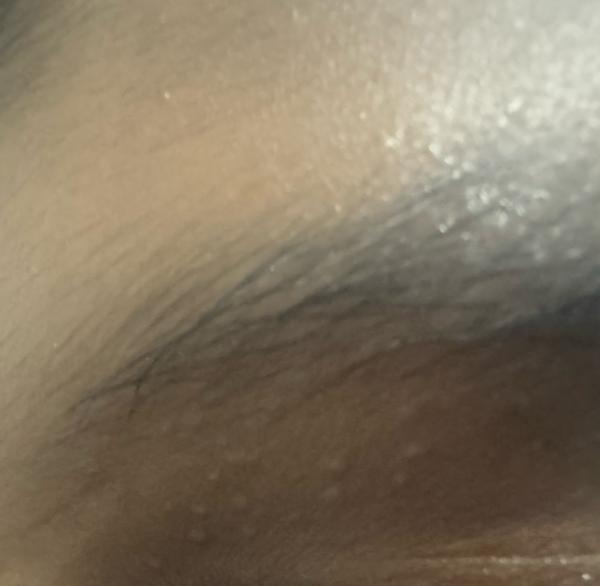 cyst removal in trichy