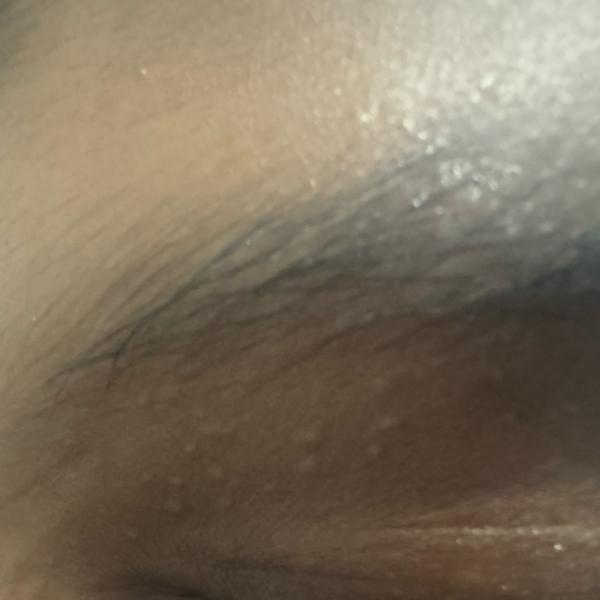 cyst removal in trichy