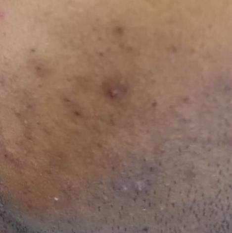 top acne treatment center in t