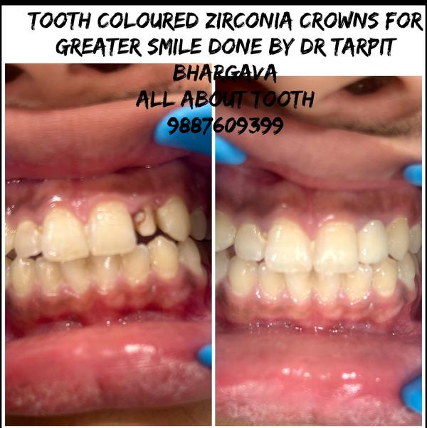 zirconia warranty caps