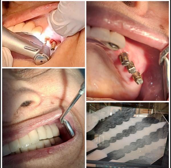 72 hours teeth (implants 