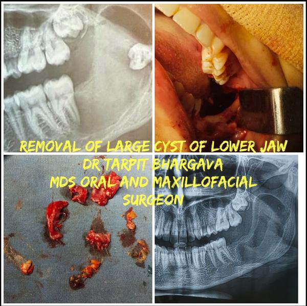 cyst removal surgery