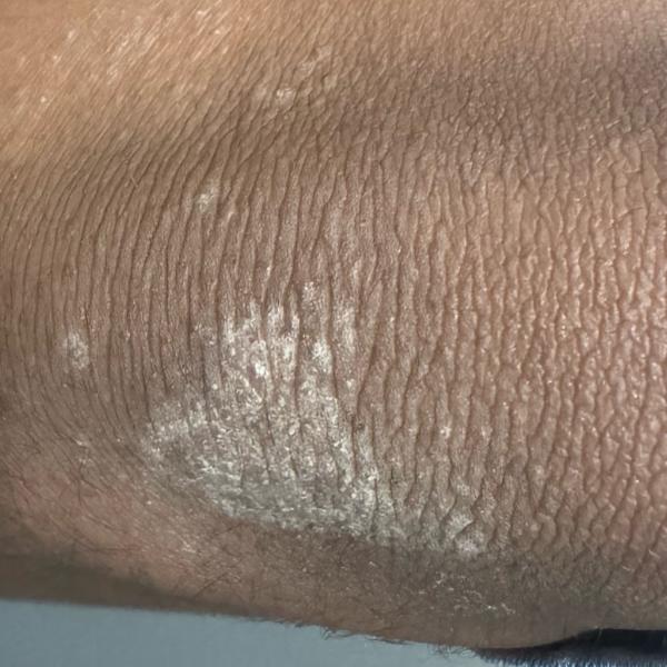 eczema treatment specialist tr