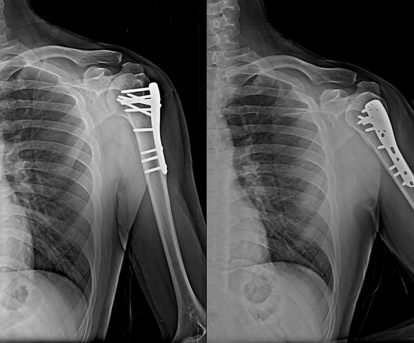 shoulder dislocation assessmen