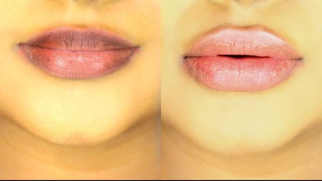 Dark lips can often be a conce