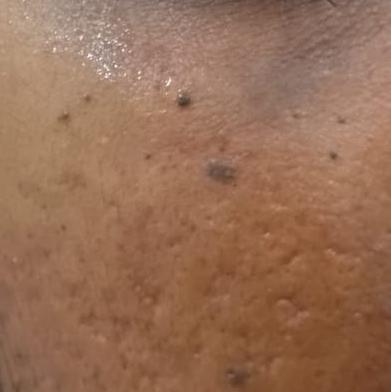 pigmentation removal trichy